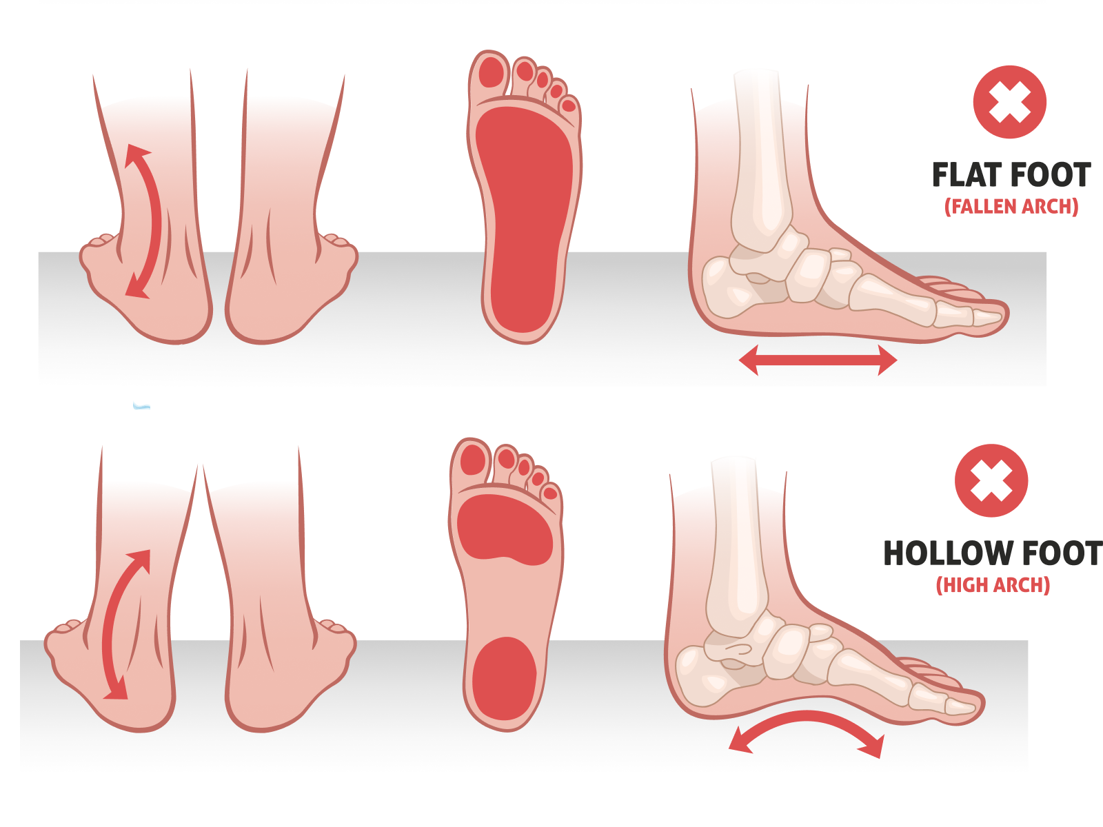 Wrong InsolesWorse Pain
